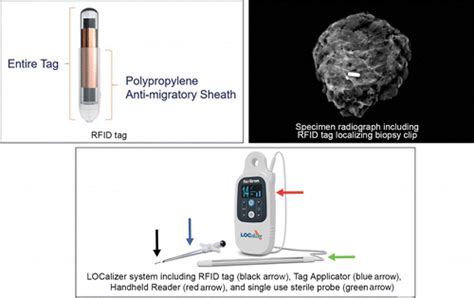 rfid tag issues|rfid tagging in breast surgery.